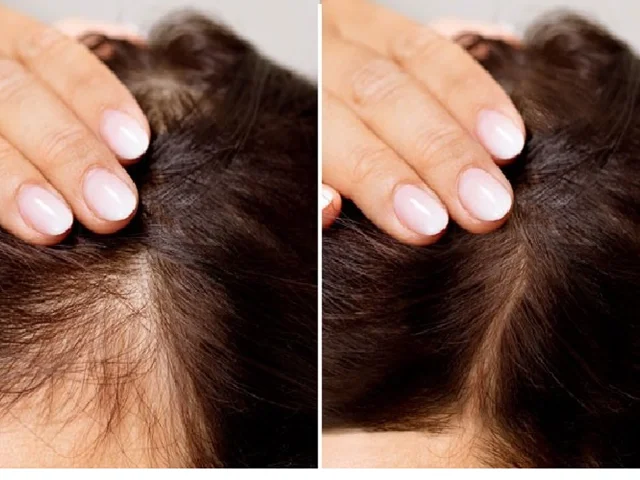 درمان خانگی ریزش مو بعد از کراتینه؛ 10 راهکارهای موثر برای بازگرداندن سلامت موها