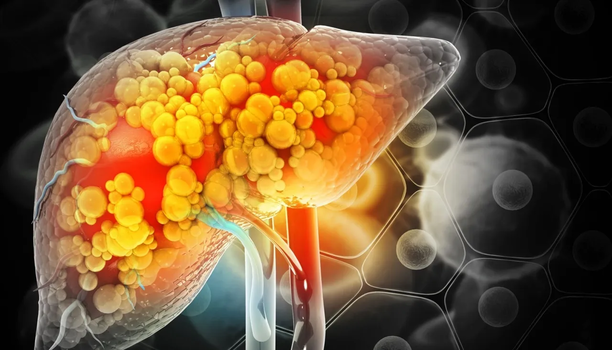 پیشگیری از ابتلا به کبد چرب الکلی